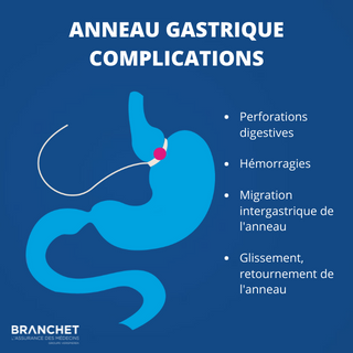 anneau gastrique complications chirurgie bariatrique